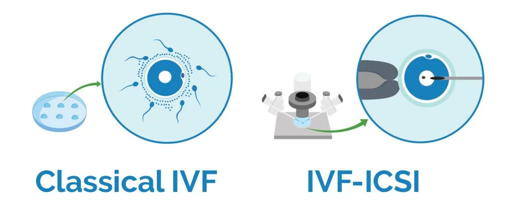 الإلقاح المساعد خارج الرحم IVF والحقن المجهري المساعد داخل البويضة ICSI وعلاج أسباب العقم الذكوري